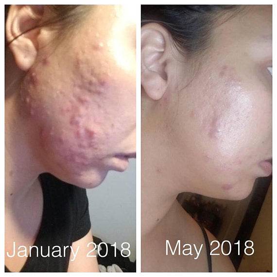 Super Acne Fighter / Organic Acne Treatment / Acne - Big J's Showstoppin' Store