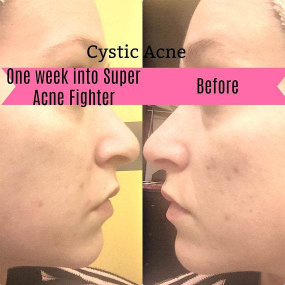 Super Acne Fighter / Organic Acne Treatment / Acne - Big J's Showstoppin' Store