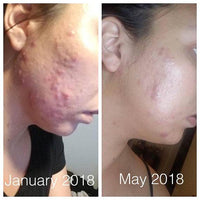 Super Acne Fighter / Organic Acne Treatment / Acne - Big J's Showstoppin' Store